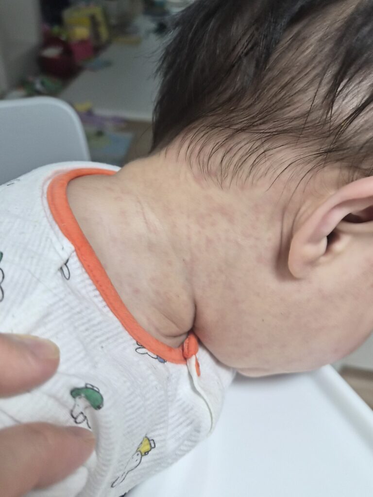 12개월 아기 돌발진 열꽃증상