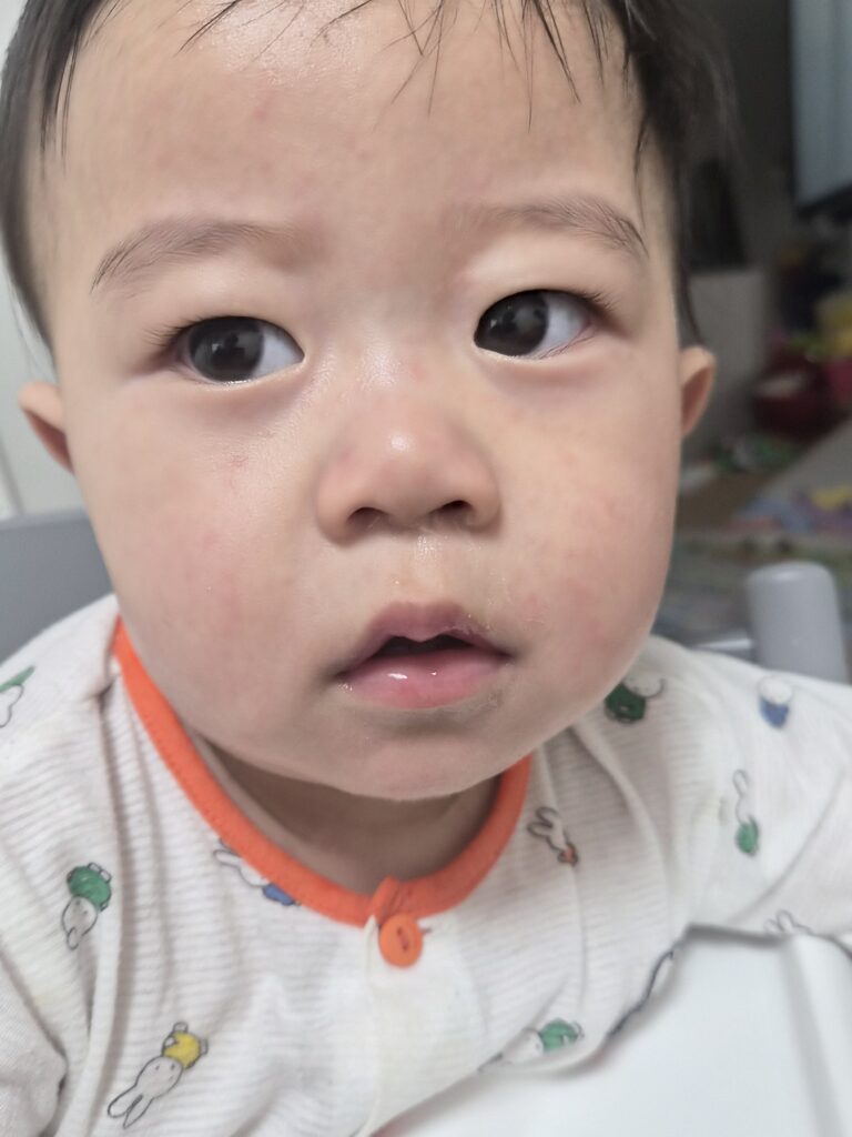 12개월 아기 돌발진 열꽃증상